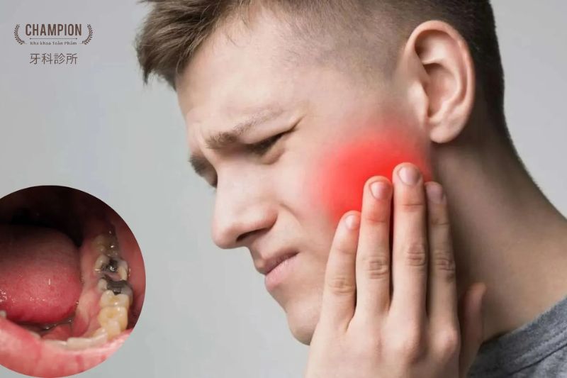 Sâu răng là gì? Nguyên nhân, triệu chứng và các cách phòng ngừa