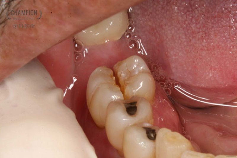 Tại sao cần bảo tồn răng vĩnh viễn