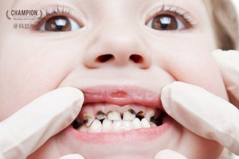 Infant Teeth Free Extraction: Champion Dental Clinic in District 7