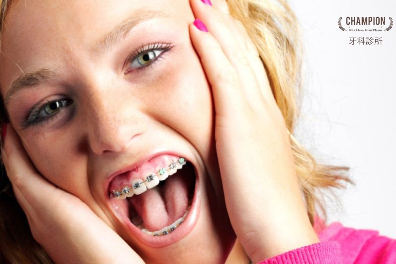Tại sao niềng răng bị hóp má? Cách khắc phục như thế nào?