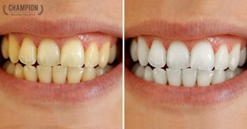Tẩy trắng răng tại phòng khám nha khoa và những điều cần biết