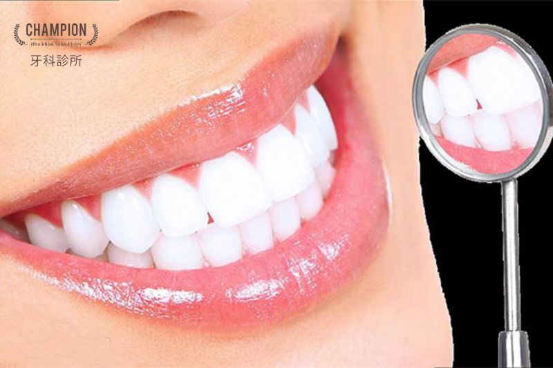 Lợi ích của việc tẩy trắng răng tại nha khoa Champion