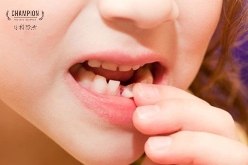 Trẻ em mấy tuổi thì bắt đầu thay răng và những lưu ý cần biết 