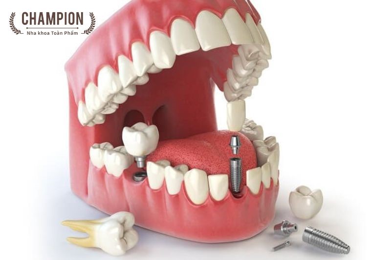 Biến chứng có thể xảy ra khi trồng răng implant thất bại