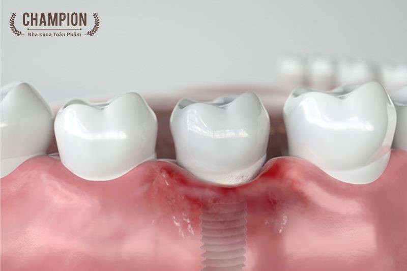 Chăm sóc Implant như thế nào để hạn chế nguy hiểm?