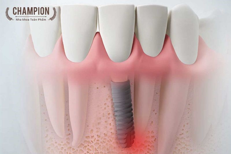 Cấy ghép Implant là gì và hoạt động như thế nào?