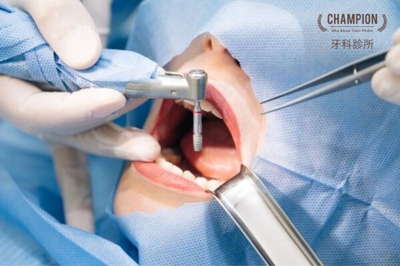 Trồng răng Implant là gì?