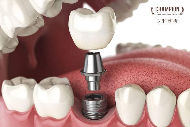 Trồng răng Implant có tốt không?