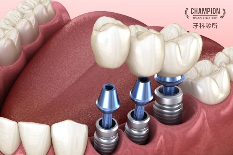 Trường hợp nào nên trồng răng Implant?