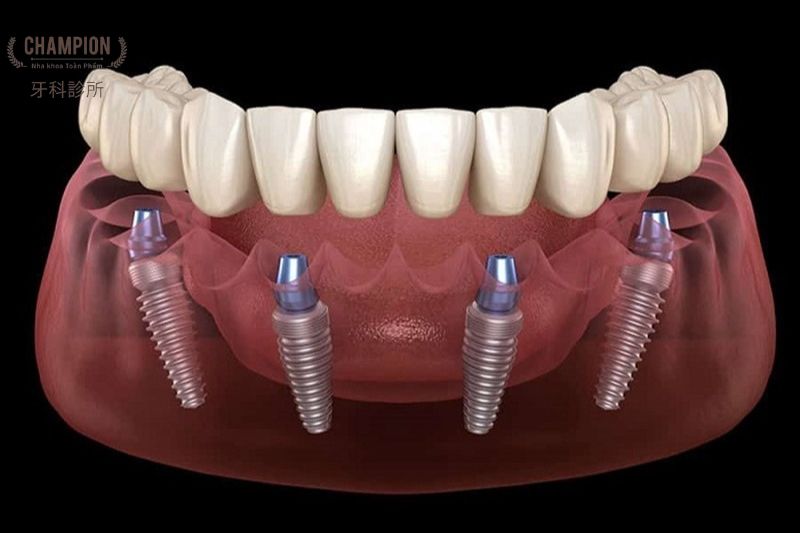 Kỹ thuật trồng răng Implant All-On-4 là gì?