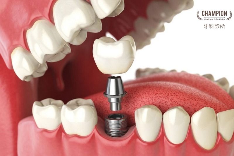 Một số lưu ý trong quá trình trồng răng Implant đơn lẻ