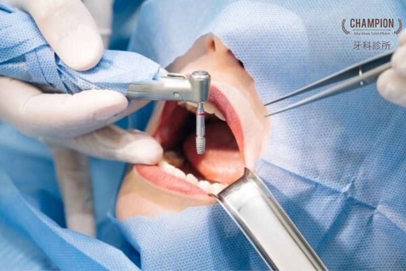 Trồng răng Implant ở đâu tốt HCM?