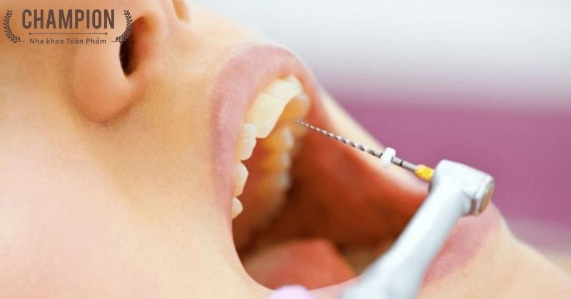 Các phương pháp chữa tủy răng cửa phổ biến hiện nay