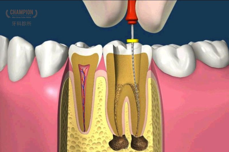 Nguyên nhân gây viêm tủy răng